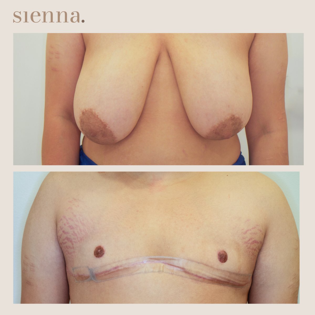 Résultats avant/après chirurgie FTM à la clinique Sienna