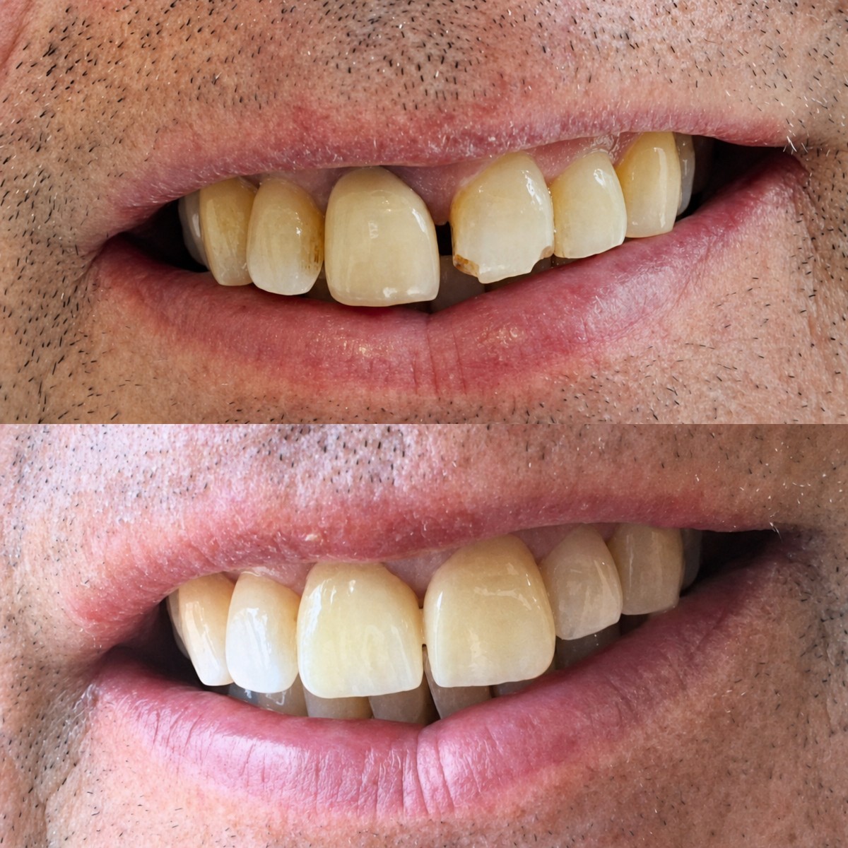 До и после установки зубных коронок в Clínica Dental Raíces, восстановленная улыбка