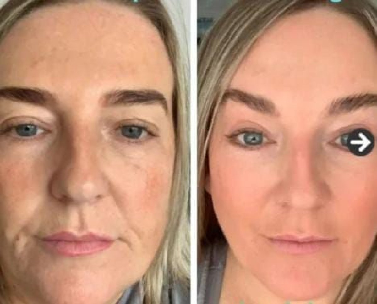 Before and after lower eyelid blepharoplasty results at Memorial Şişli Hospital, rejuvenated look