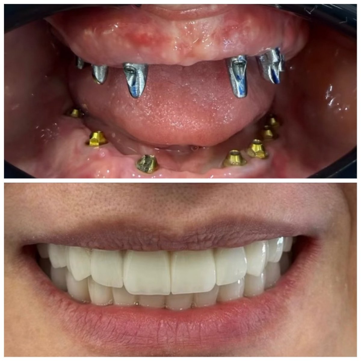 Before and after dental implant results at Dentaland Premium Luxury Clinic & Academy, smile restoration