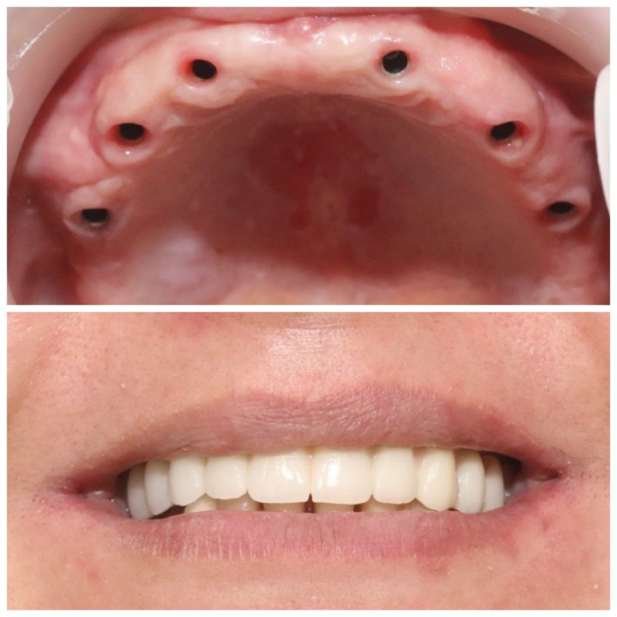 Before and after dental implant results at Dentaland Premium Luxury Clinic & Academy, restored smile