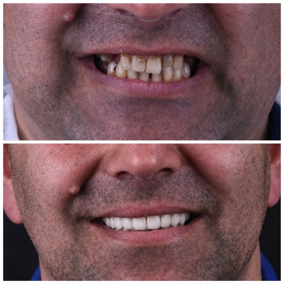 Résultats avant et après implant dentaire à Dentaland Premium Luxury Clinic & Academy, sourire restauré
