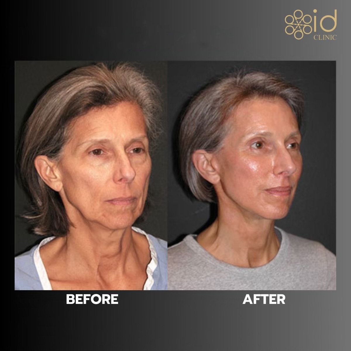 Before and after deep plane facelift results at ID Clinic Bangkok, visible facial rejuvenation