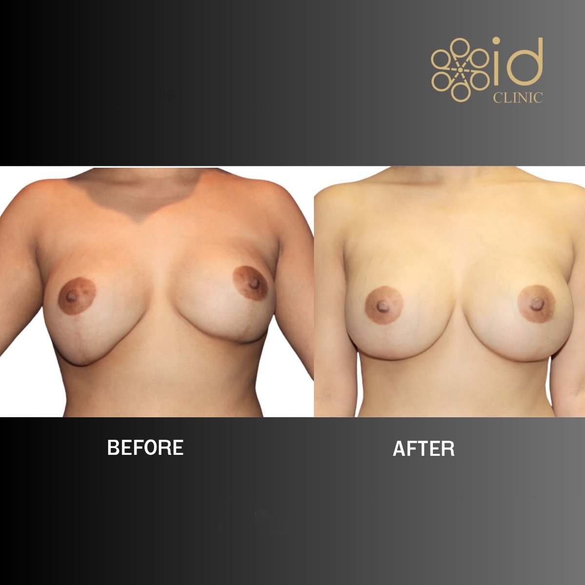 Before and after breast implant revision results at ID Clinic Bangkok, improved breast shape