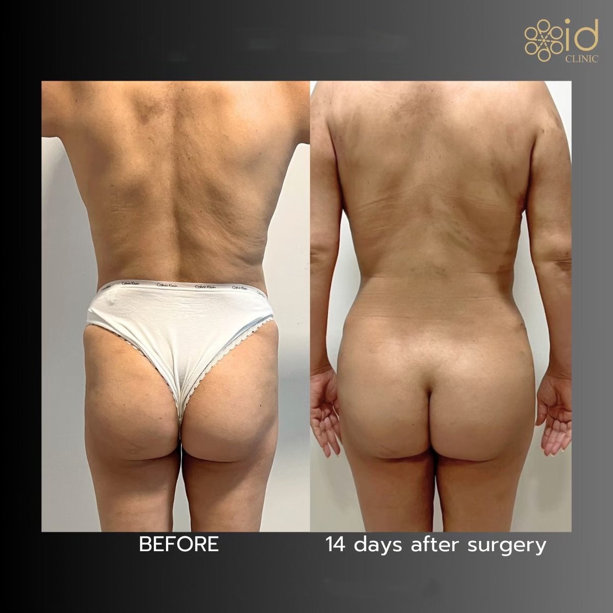 360 liposuction before and after results at ID Clinic Bangkok, visible body contour improvement