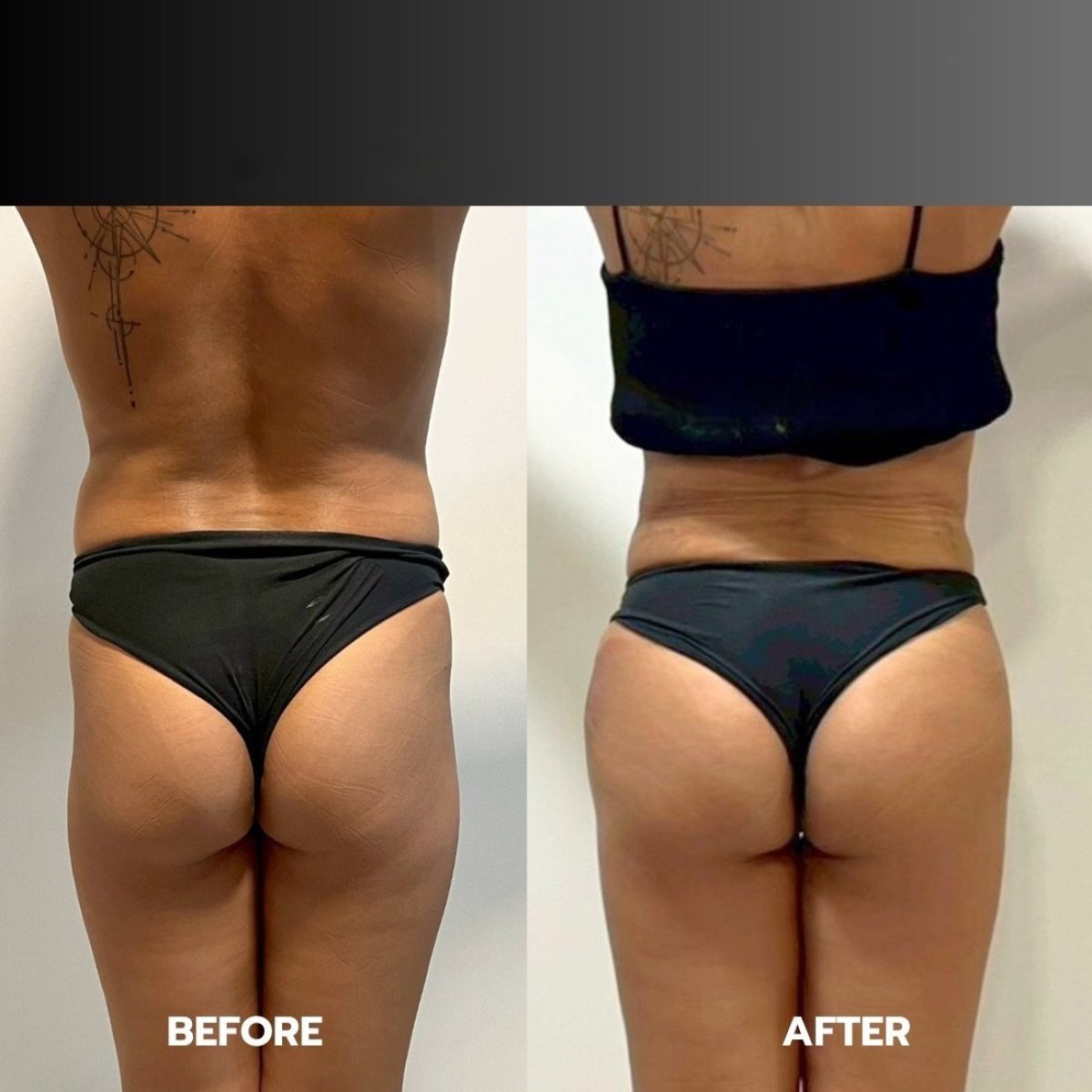 Before and after 360 liposuction results at ID Clinic Bangkok, improved waist and contour