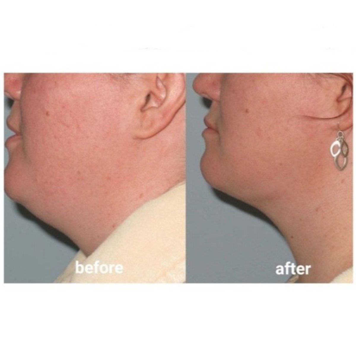 Before and after Vaser liposuction results at ID Clinic Bangkok, improved chin contour