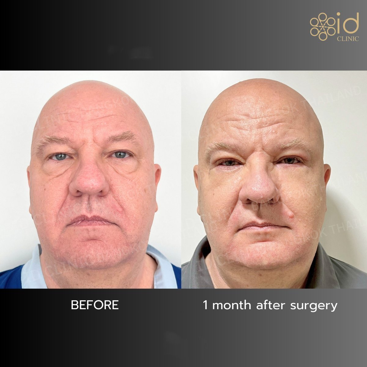 Lower eyelid blepharoplasty before and after results at ID Clinic Bangkok, 1 month post-op