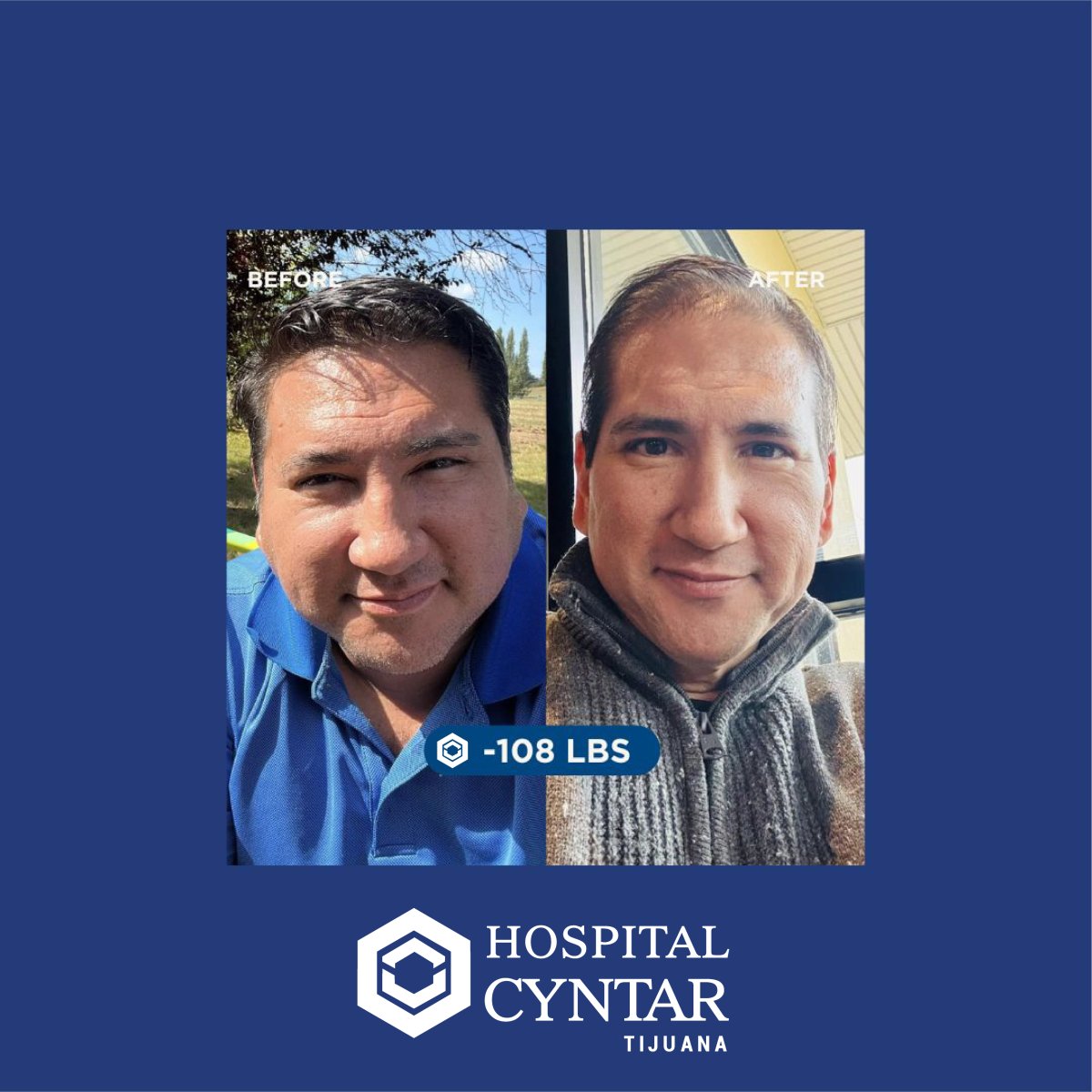 Результаты до и после гастрошунтирования в HOSPITAL CYNTAR TIJUANA, минус 49 кг