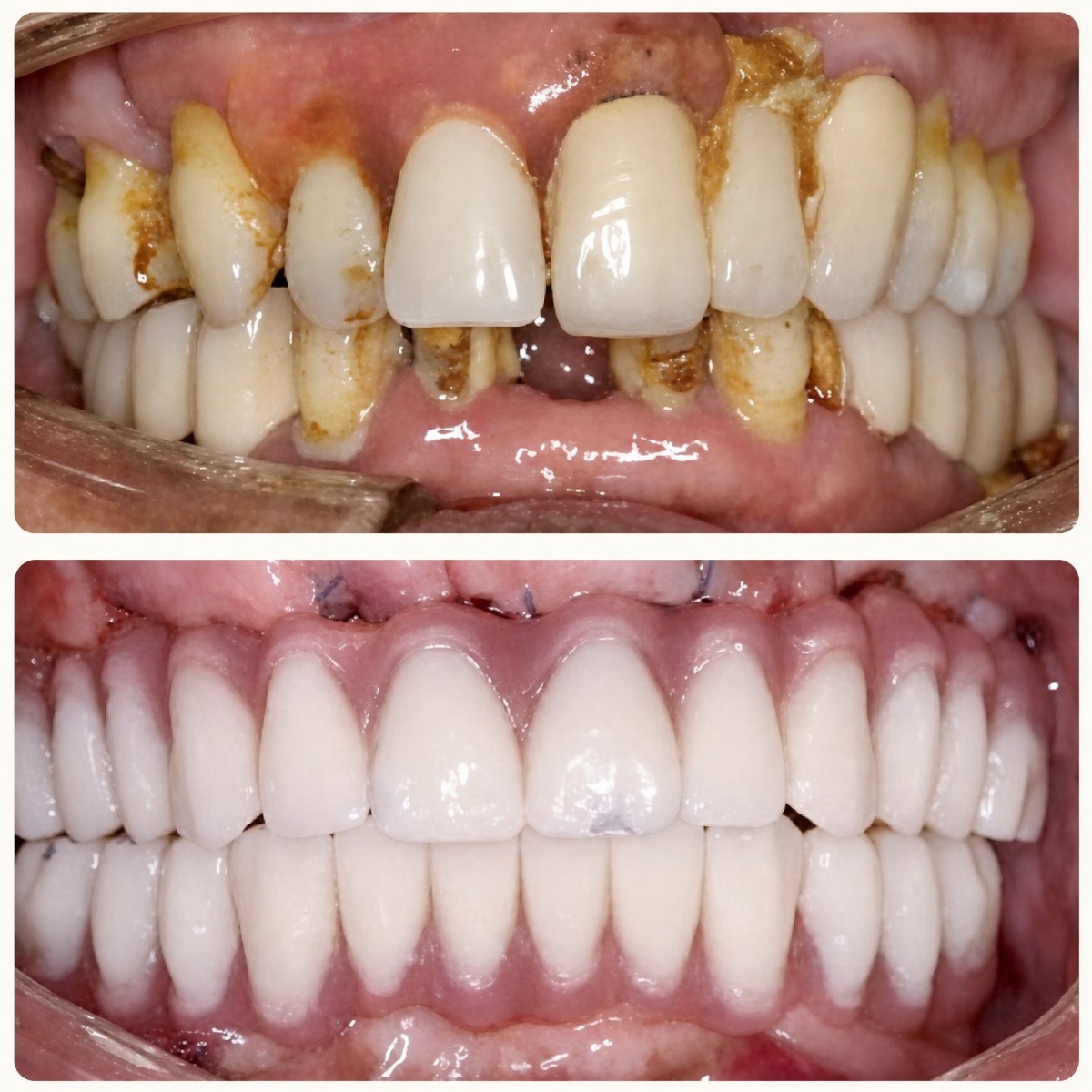 Resultados antes y después de implantes All-on-4 en Shanghai Y+bo Dental Clinic, restauración de sonrisa