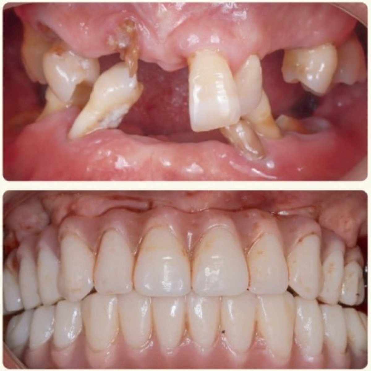 Результат до і після імплантації All-on-4 у Shanghai Y+bo Dental Clinic, повне відновлення усмішки