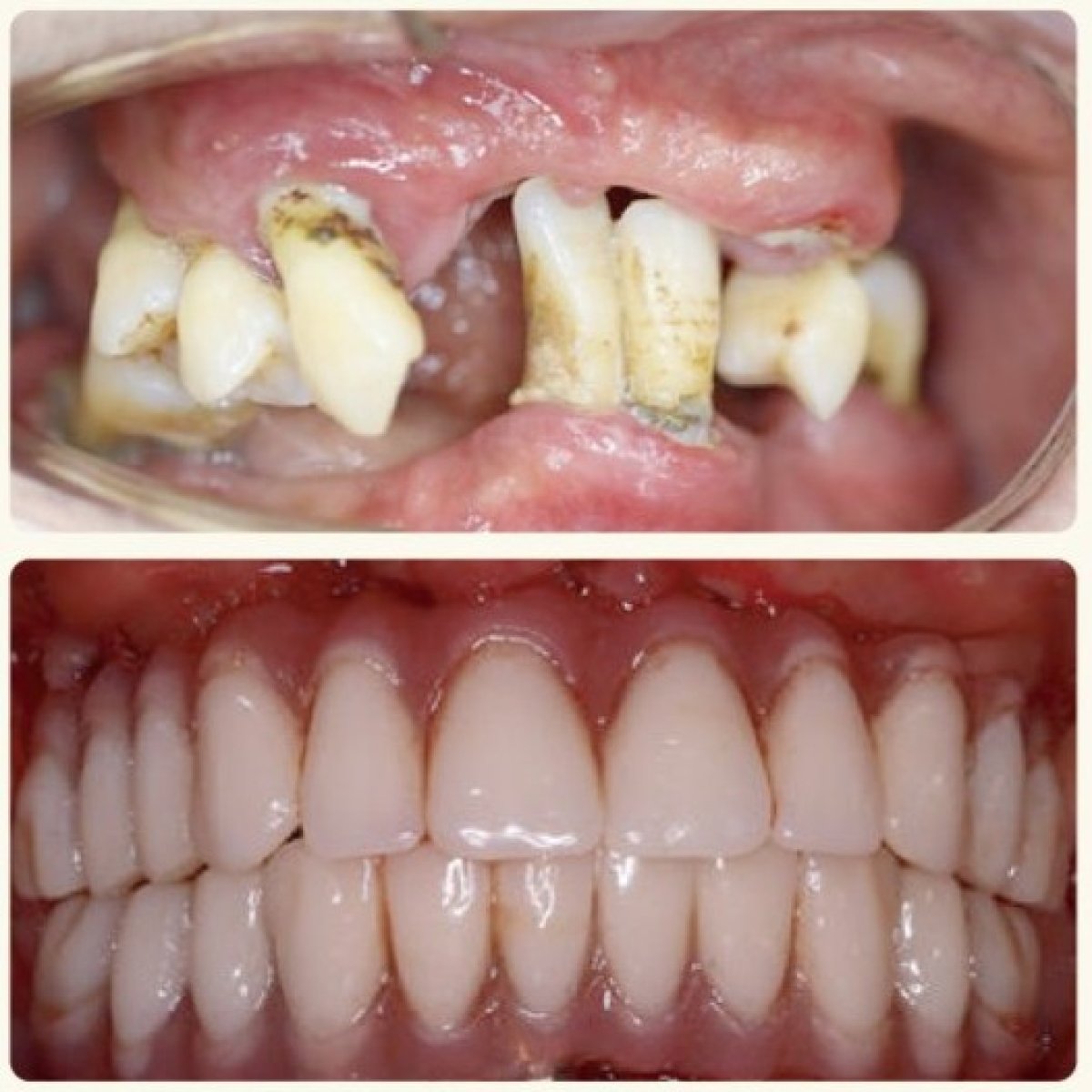 Résultat avant et après implants All-on-4 à la Shanghai Y+bo Dental Clinic, restauration complète du sourire