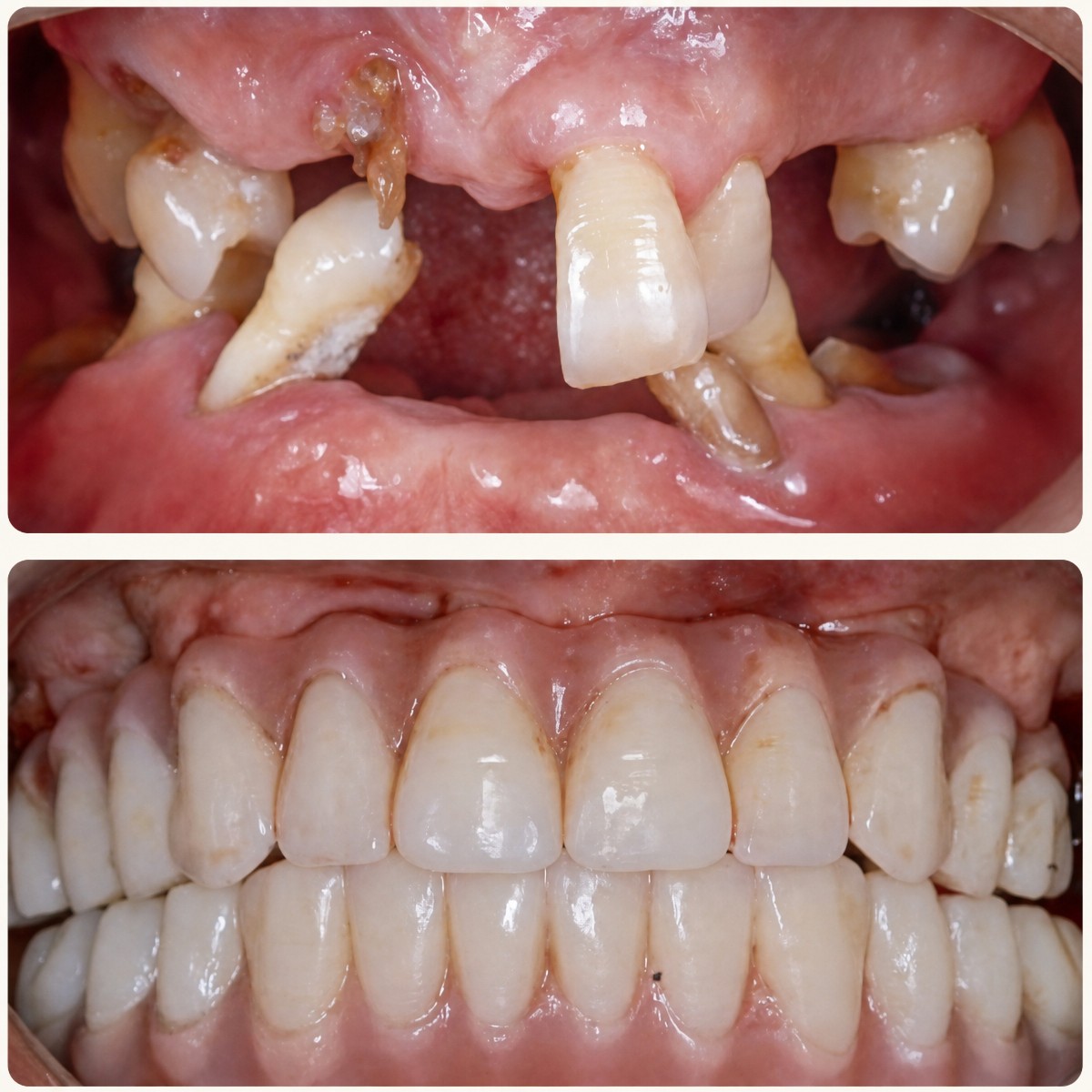 Résultat avant/après implants dentaires All-on-6 à la clinique Shanghai Y+bo, restauration complète du sourire