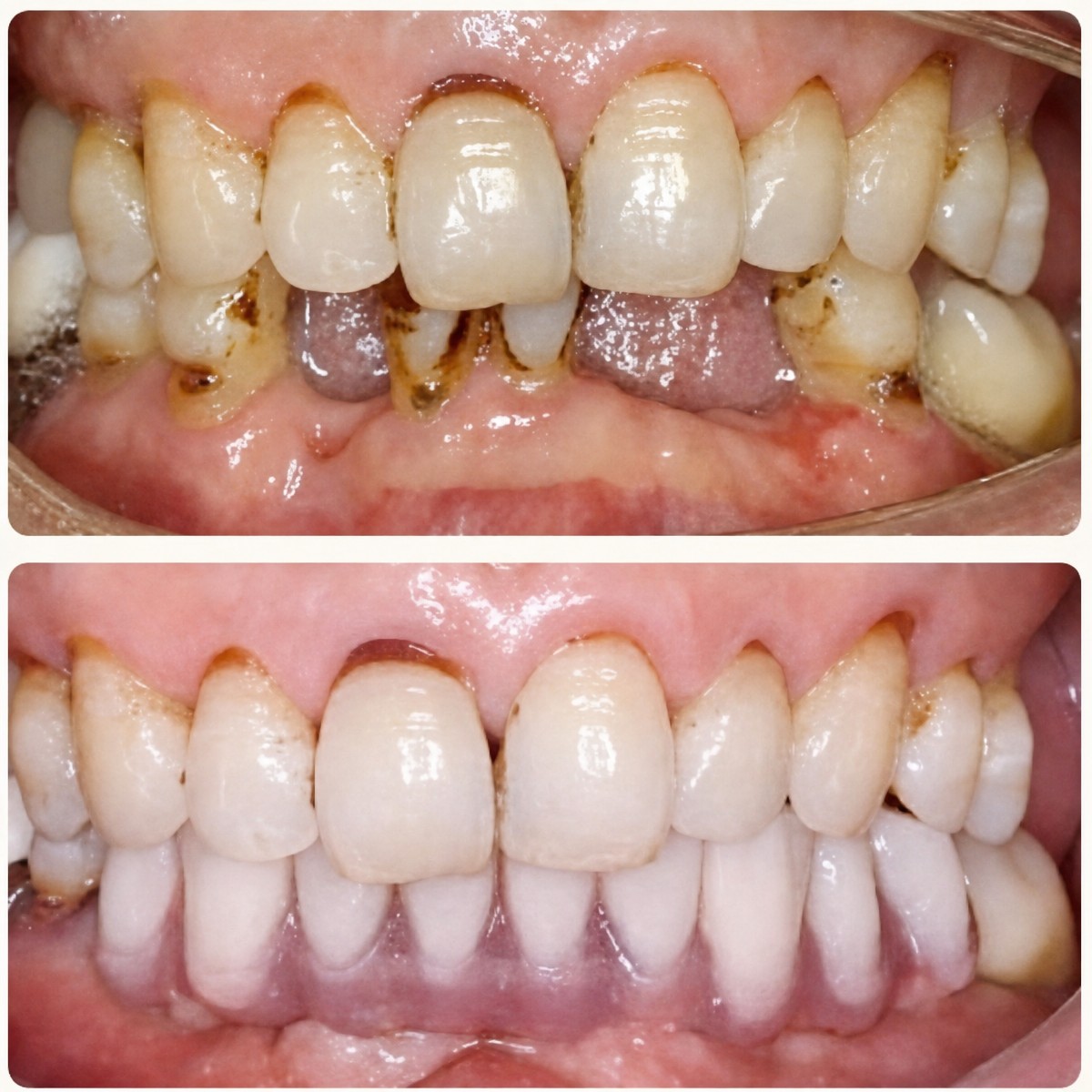Before and after All-on-6 dental implants result at Shanghai Y+bo Dental Clinic, restored smile