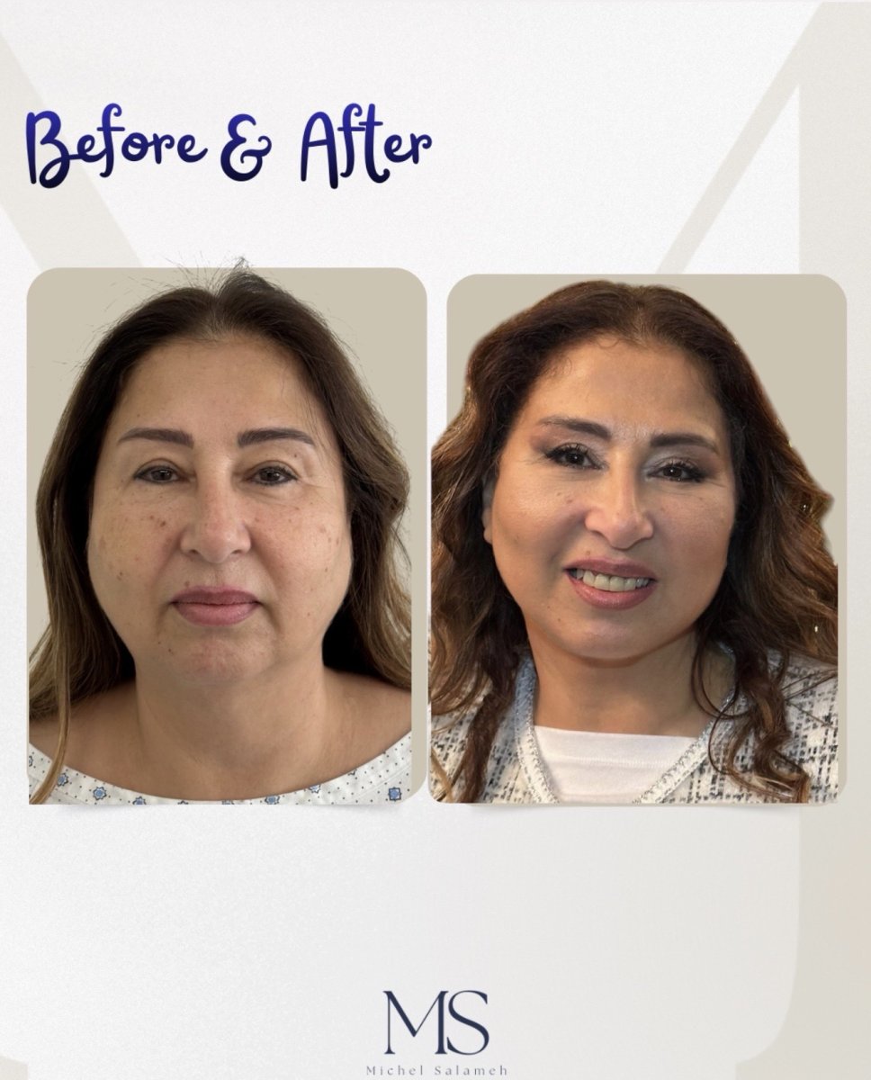 Resultados de blefaroplastia antes y después en Dr. Michel Salameh - Plastic And Aesthetic Surgery