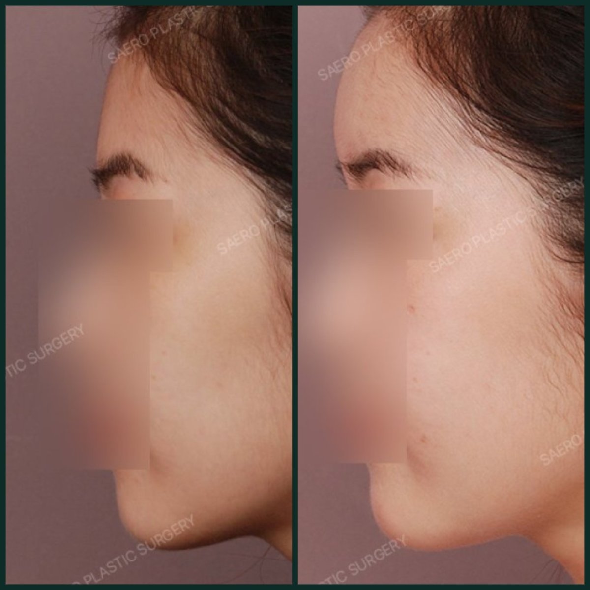 قبل وبعد نقل دهون الوجه في SAERO Plastic Surgery، نتيجة تحسين حجم الوجه