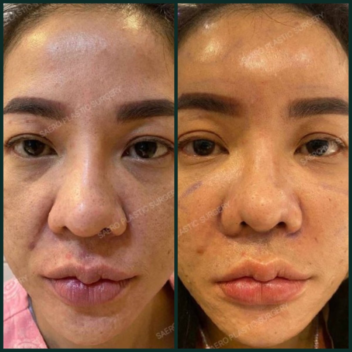 نتائج قبل وبعد نقل دهون الوجه في SAERO Plastic Surgery، زيادة امتلاء الوجه
