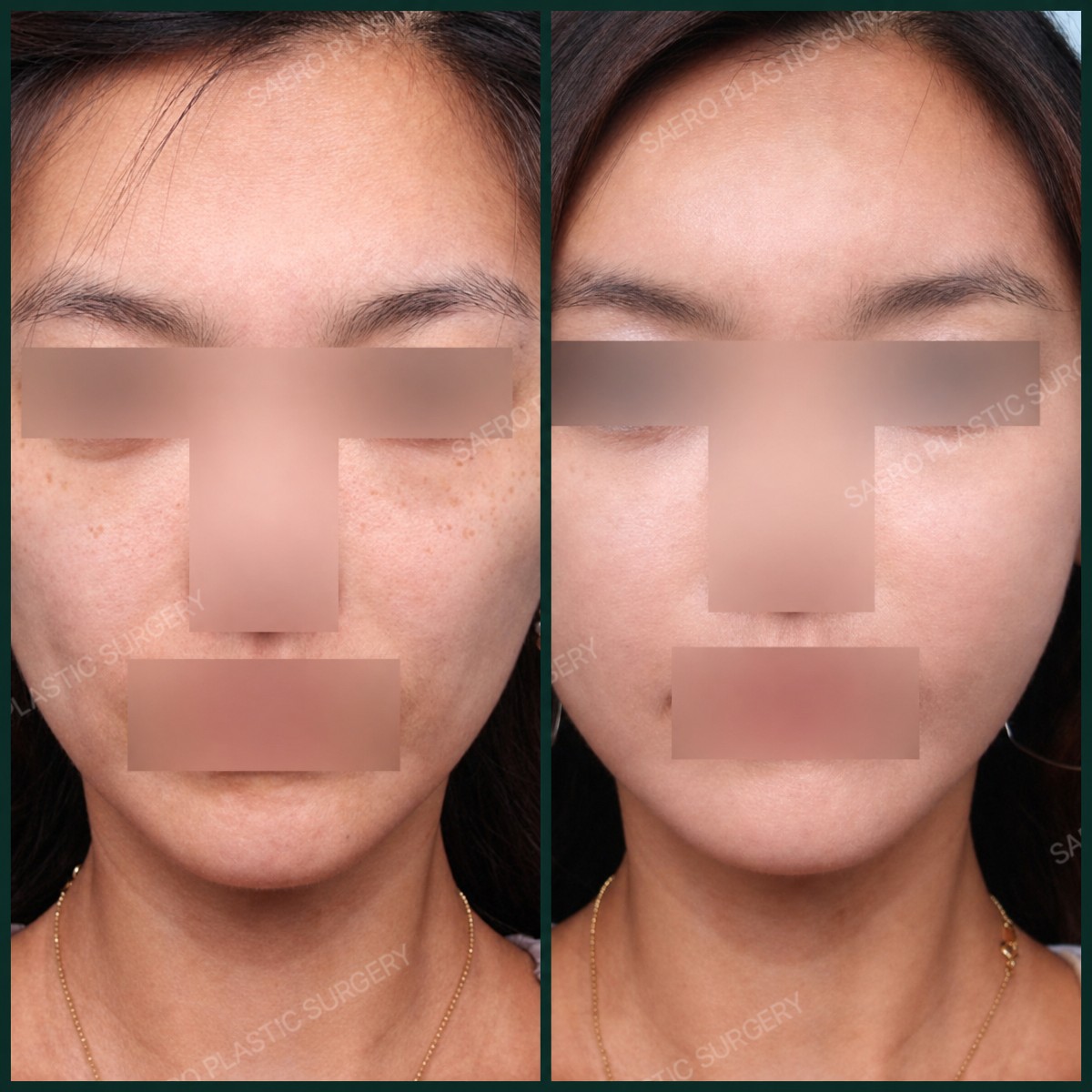 قبل وبعد نقل دهون الوجه في SAERO Plastic Surgery، نتيجة تحسين حجم الوجه