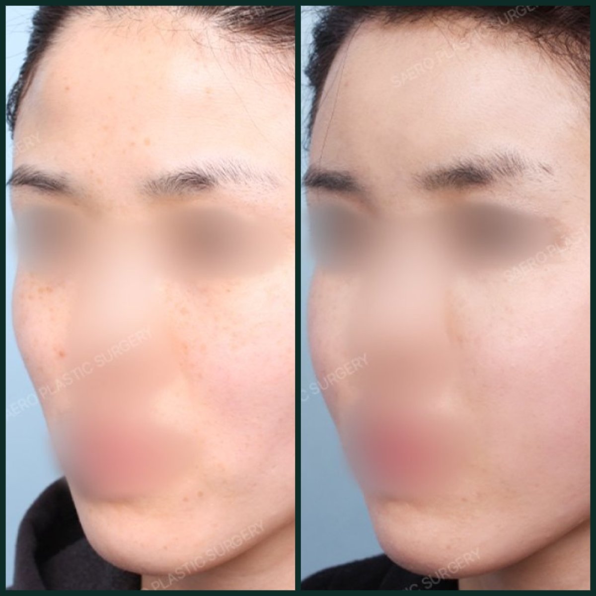 نتائج حقن الدهون للوجه قبل وبعد في SAERO Plastic Surgery، زيادة حجم الوجه