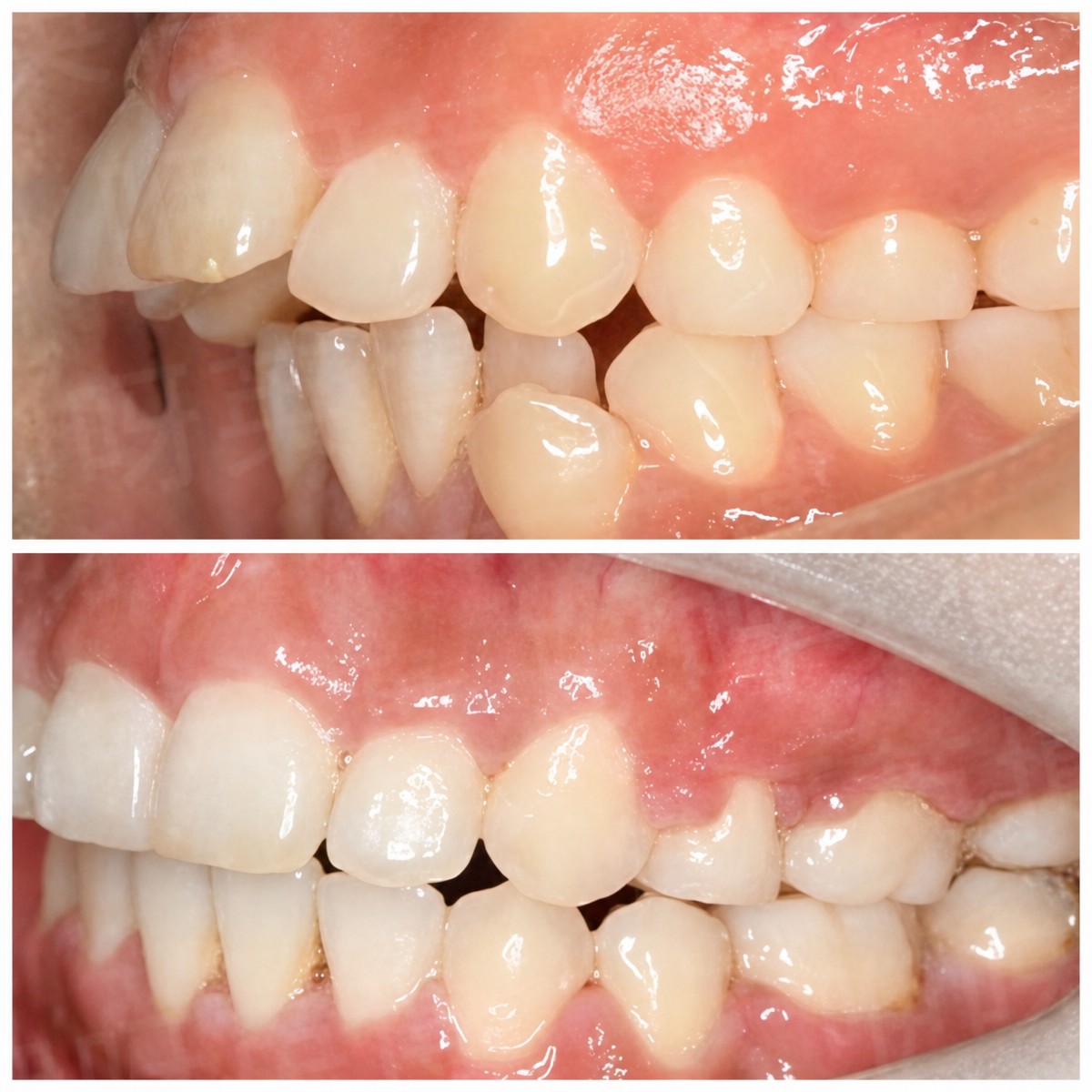 Результат до і після елайнерів у Wuhan Yiya Simei Dental Hospital, покращене вирівнювання зубів