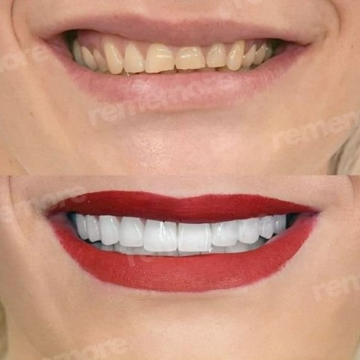 Before and after veneers at Memorial Şişli Hospital, smile transformation and whiter teeth result