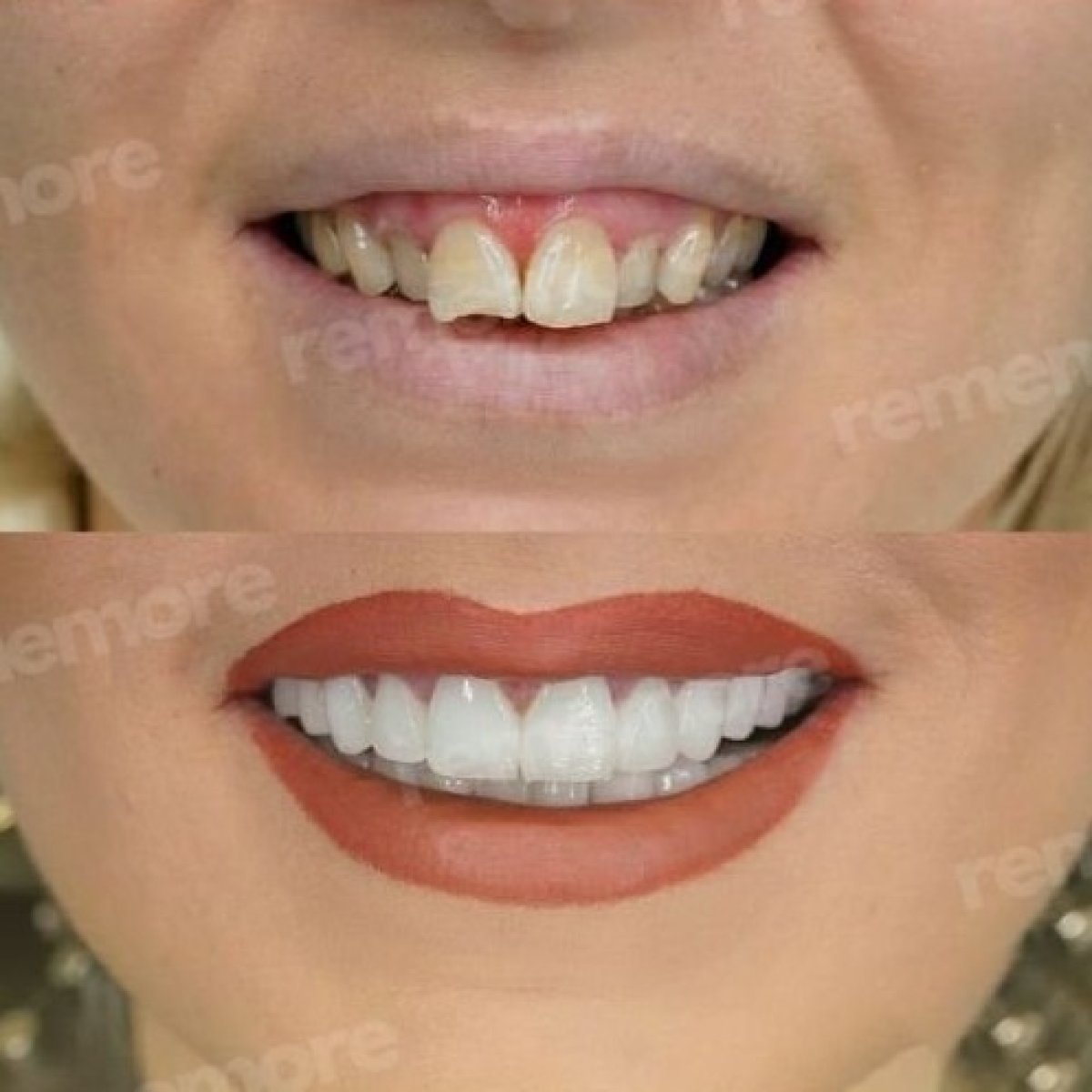 Before and after veneers at Memorial Şişli Hospital – smile makeover with natural results