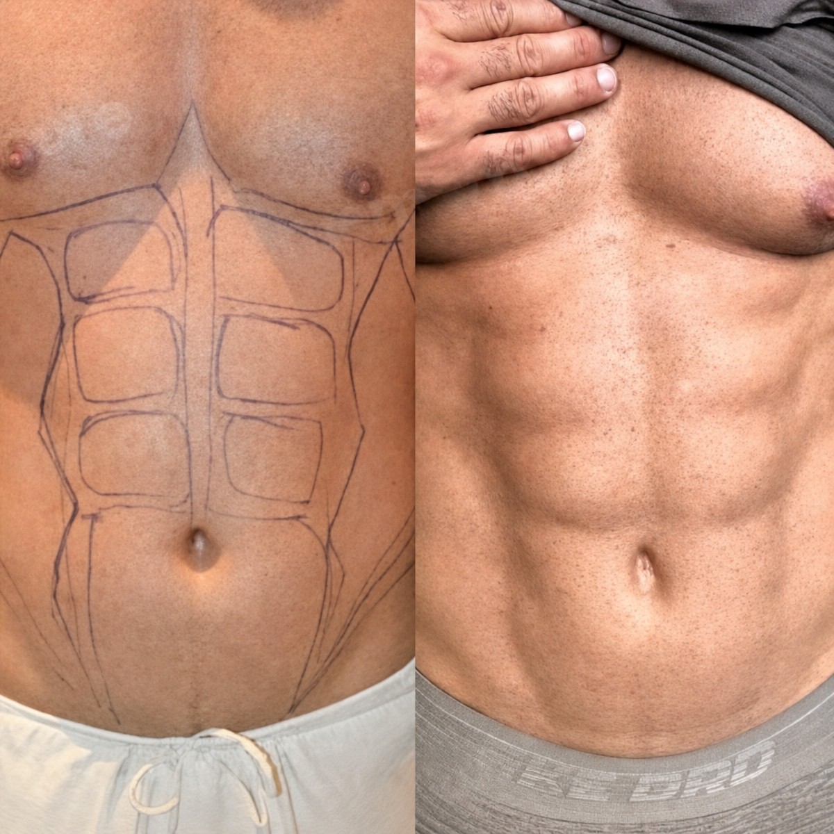 Before and after abdominal liposuction results at Memorial Şişli Hospital, defined abs contour