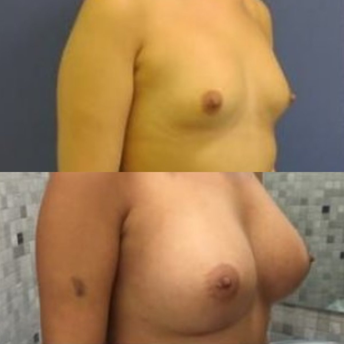 Before and after breast implants with lift at Memorial Şişli Hospital, enhanced breast shape result