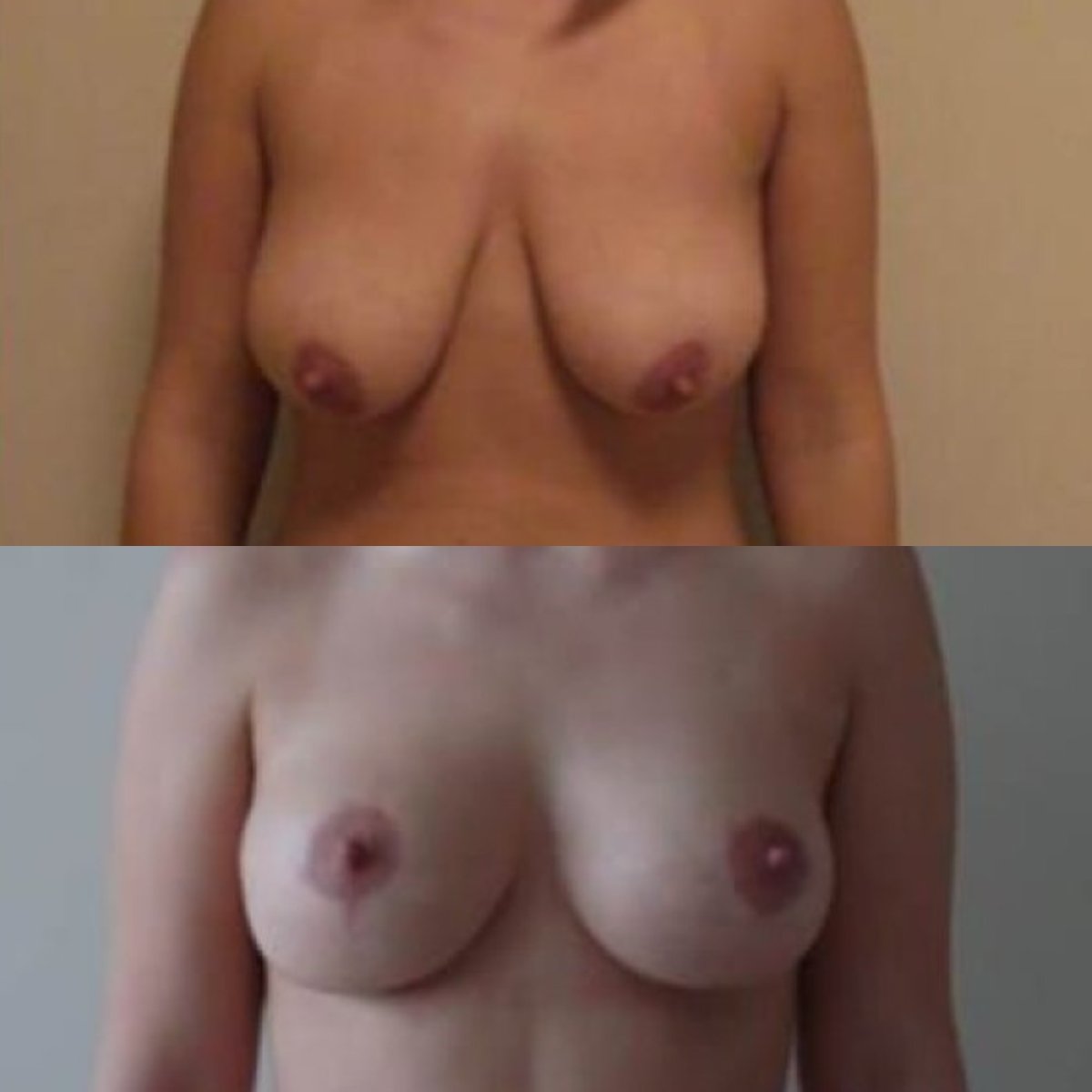 Before and after breast implants with lift at Memorial Şişli Hospital, enhanced breast shape result