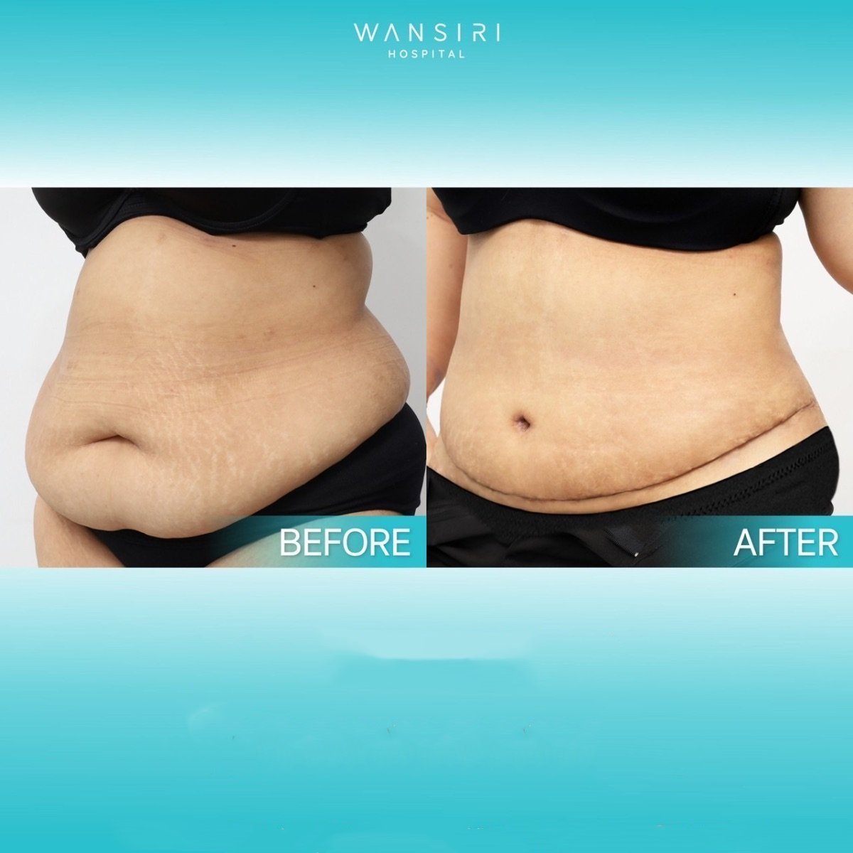 Before and after liposuction at Wansiri Hospital, visible abdominal contouring results