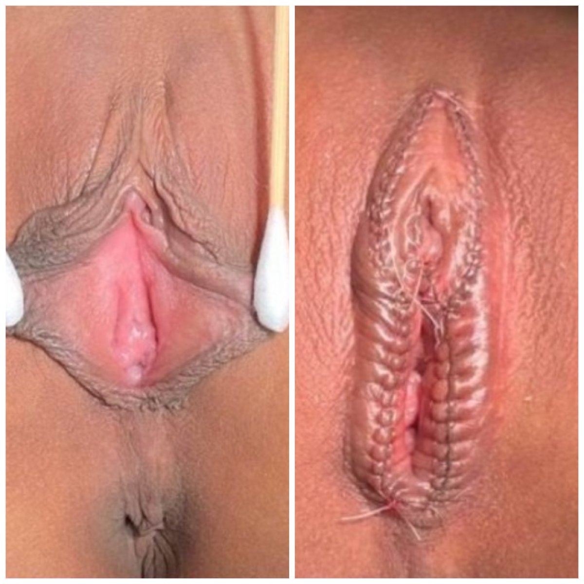 نتائج قبل وبعد عملية تجميل الشفرين في عيادة Somchai – مظهر محسن للشفرين