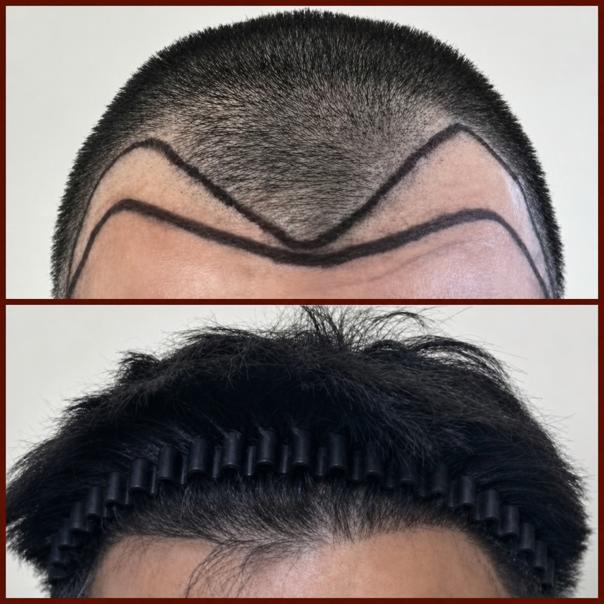 Avant et après greffe de cheveux à la DGB Clinic – ligne et densité capillaire restaurées
