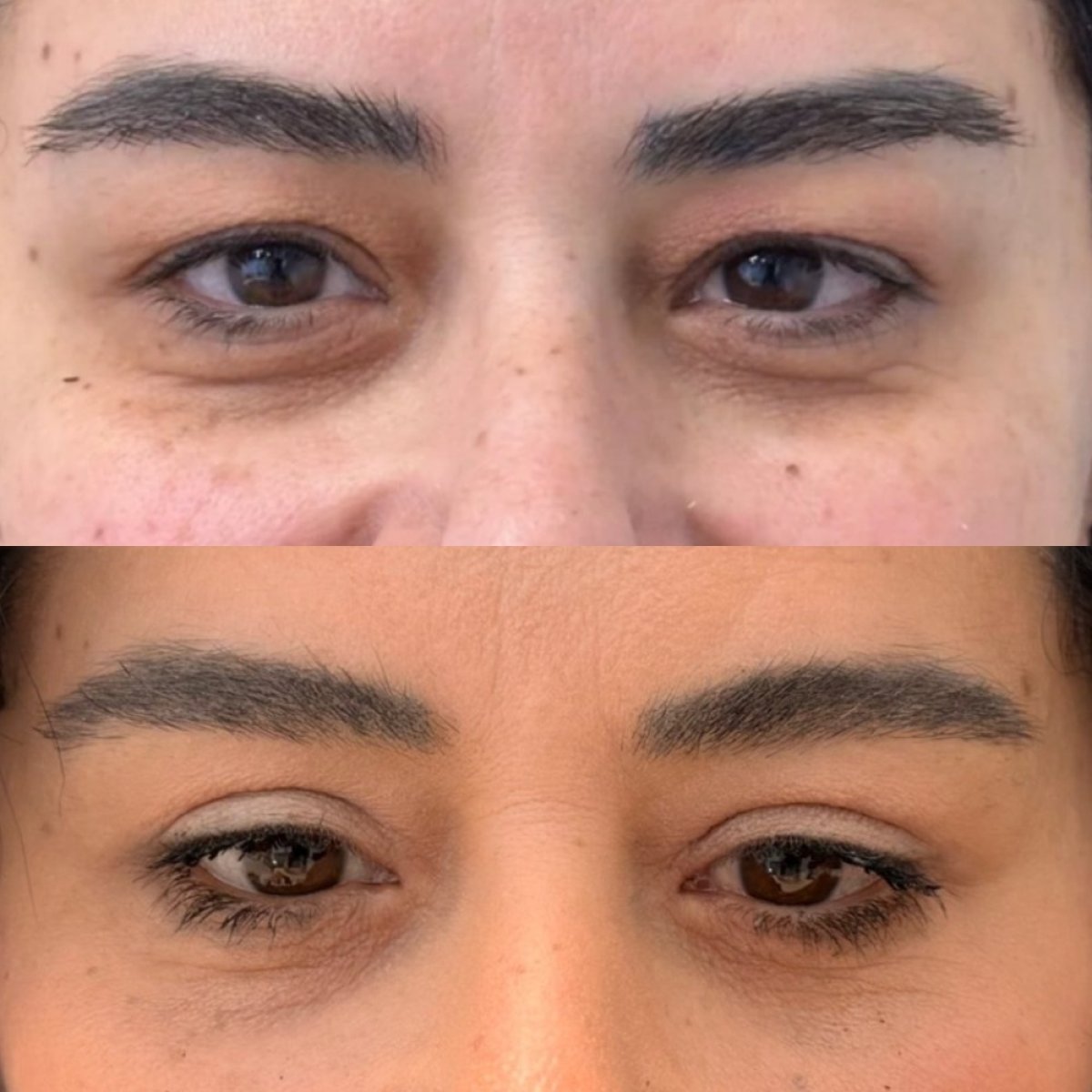 Resultados de blefaroplastia antes y después en Dr. Michel Salameh - Plastic And Aesthetic Surgery