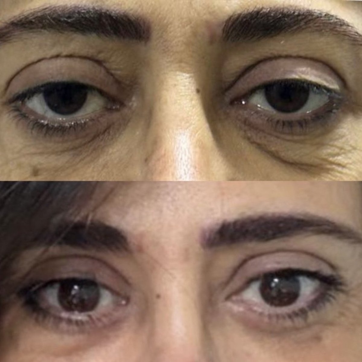 Resultados de blefaroplastia antes y después en Dr. Michel Salameh - Plastic And Aesthetic Surgery