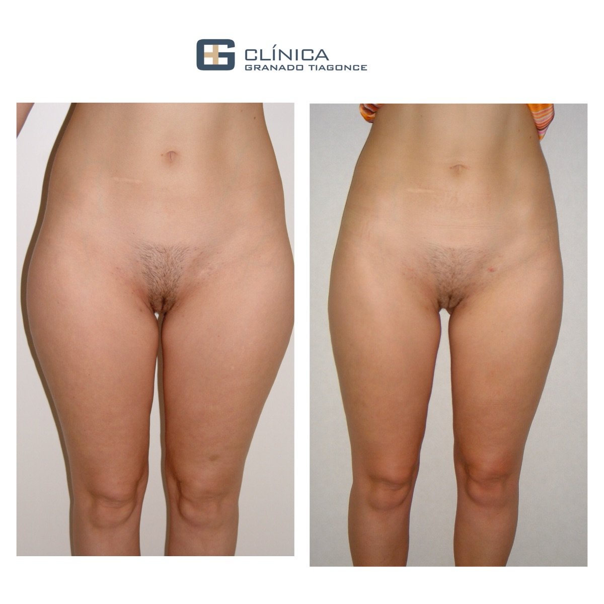 Before and after liposculpture results at Clinica Granado Tiagonce, improved body contour