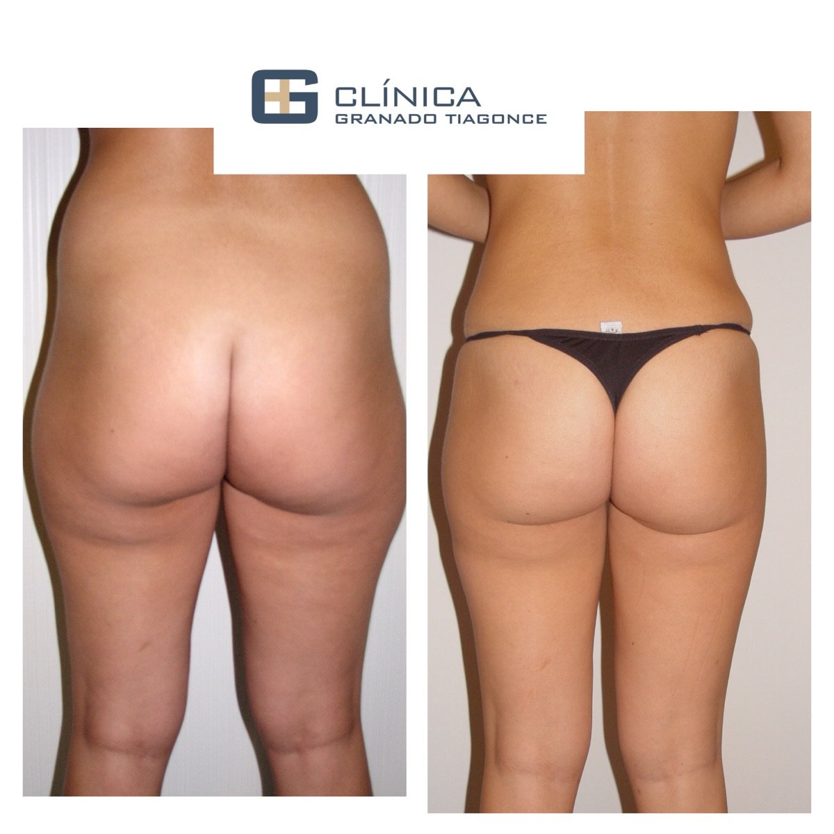 Before and after liposculpture results at Clinica Granado Tiagonce, improved body contour