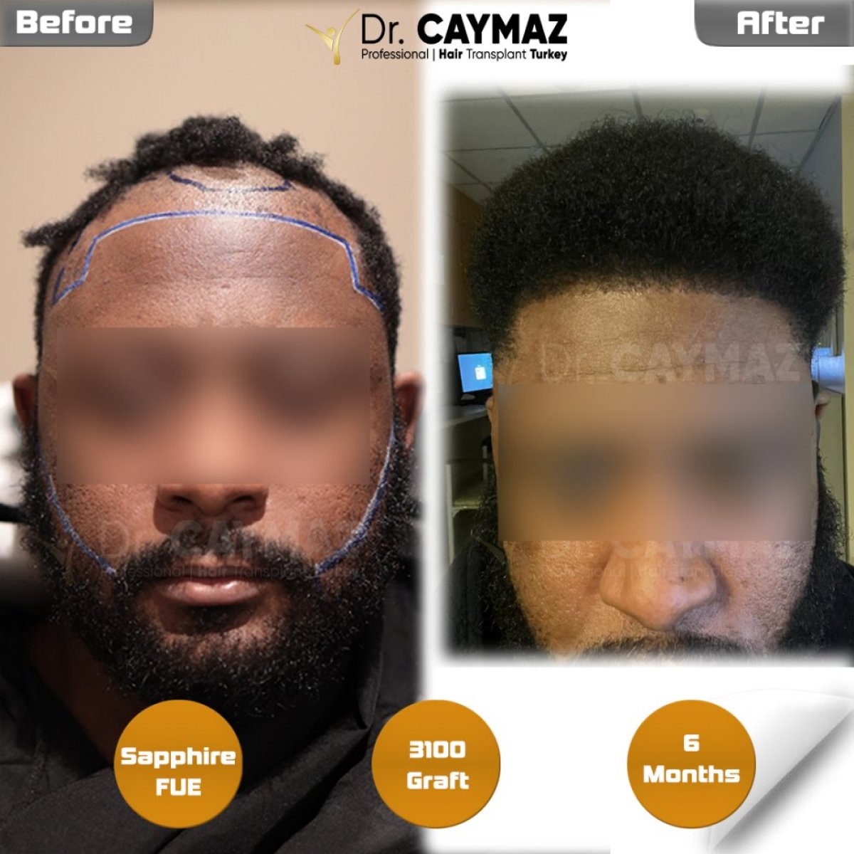نتيجة زراعة الشعر Sapphire FUE قبل وبعد في عيادة Dr. Erkam Caymaz