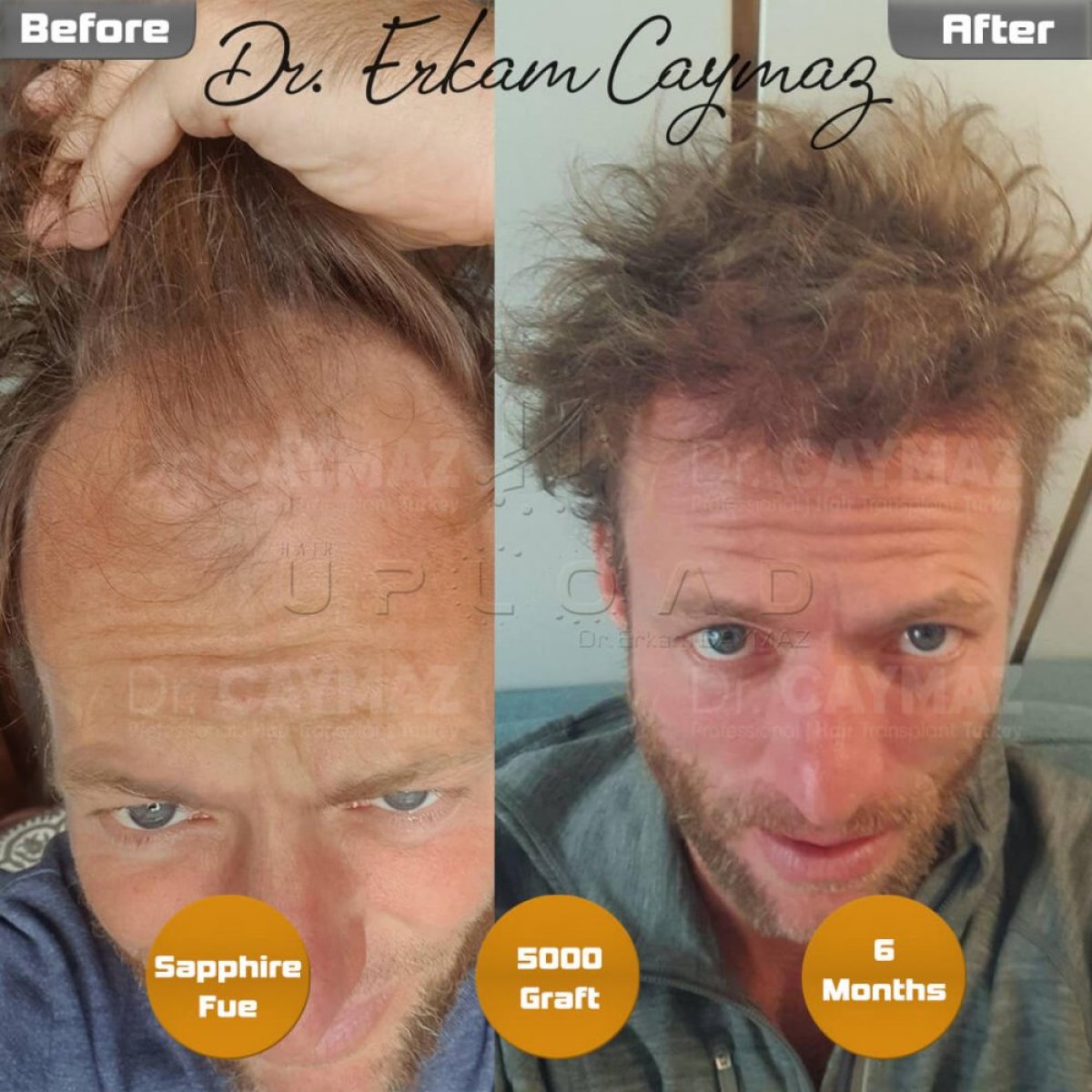 Résultat greffe de cheveux Sapphire FUE avant/après à la clinique Dr. Erkam Caymaz