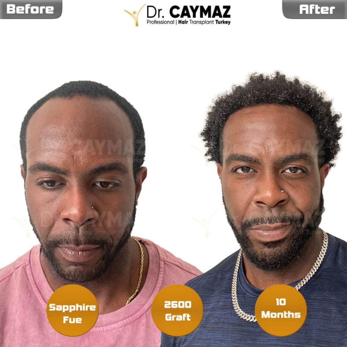 Before and after Sapphire FUE hair transplant at Dr. Erkam Caymaz's clinic, 2600 grafts result