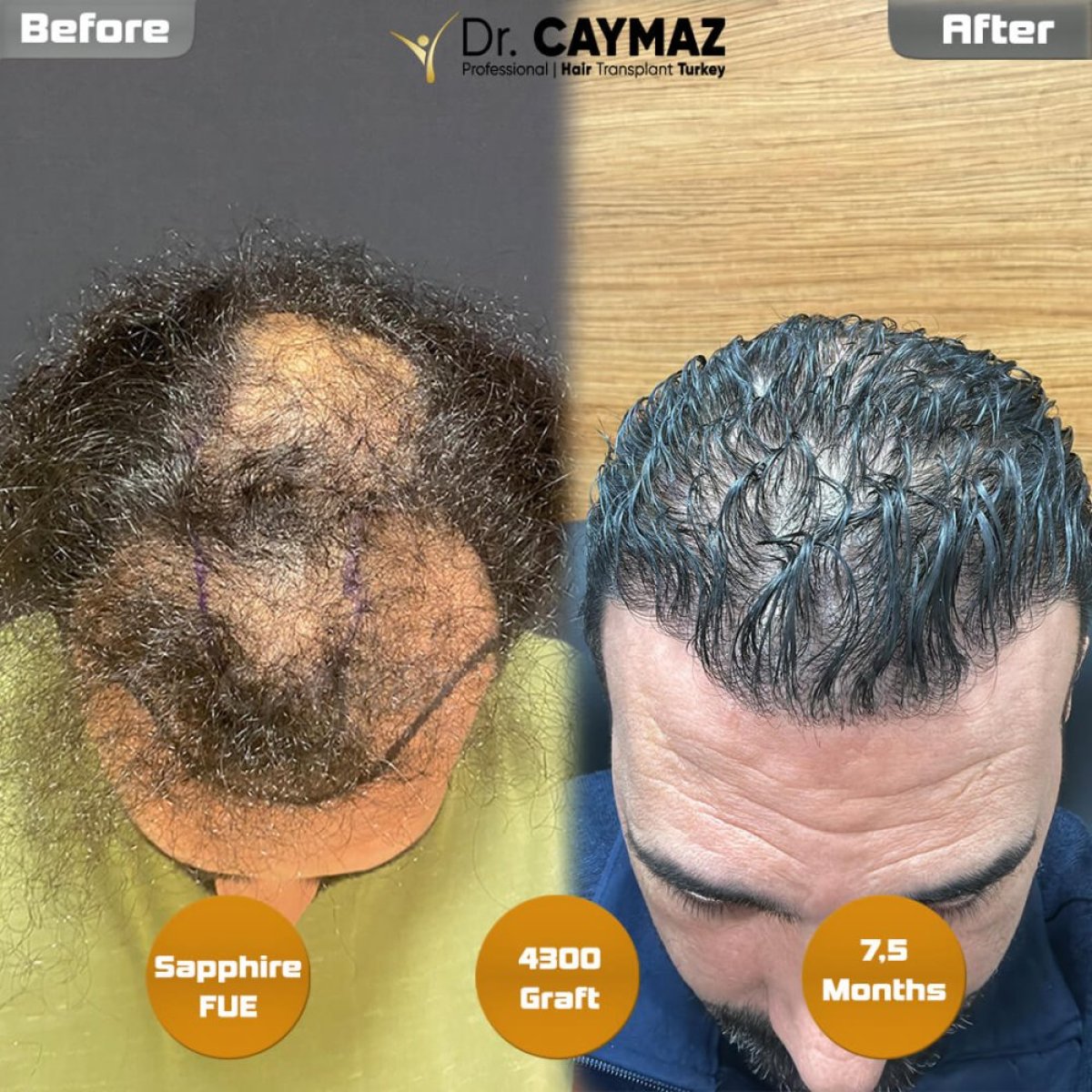 Sapphire FUE hair transplant result at Dr. Erkam Caymaz's clinic, 4300 grafts, 7.5 months