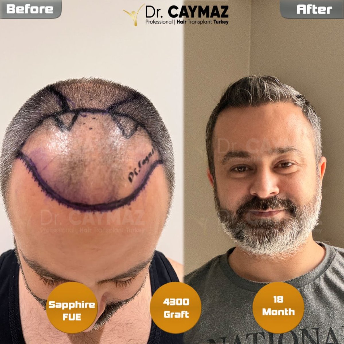 Before and after Sapphire FUE hair transplant result at Dr. Erkam Caymaz's Hair Upload Clinic