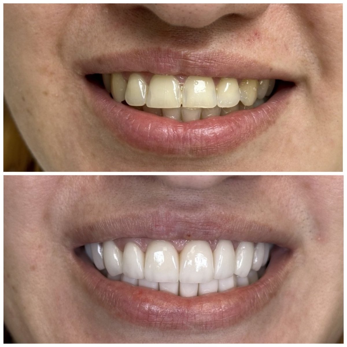 Результаты до и после бондинга зубов в VerMax Dental Clinic – улучшение улыбки