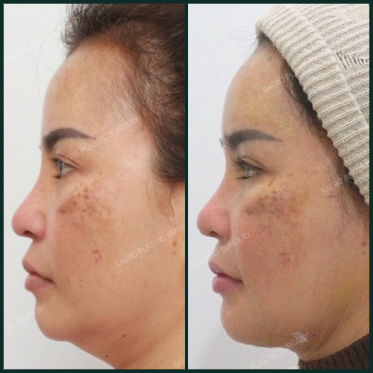Resultados de liposucción antes y después en SAERO Plastic Surgery, mejora visible del contorno facial