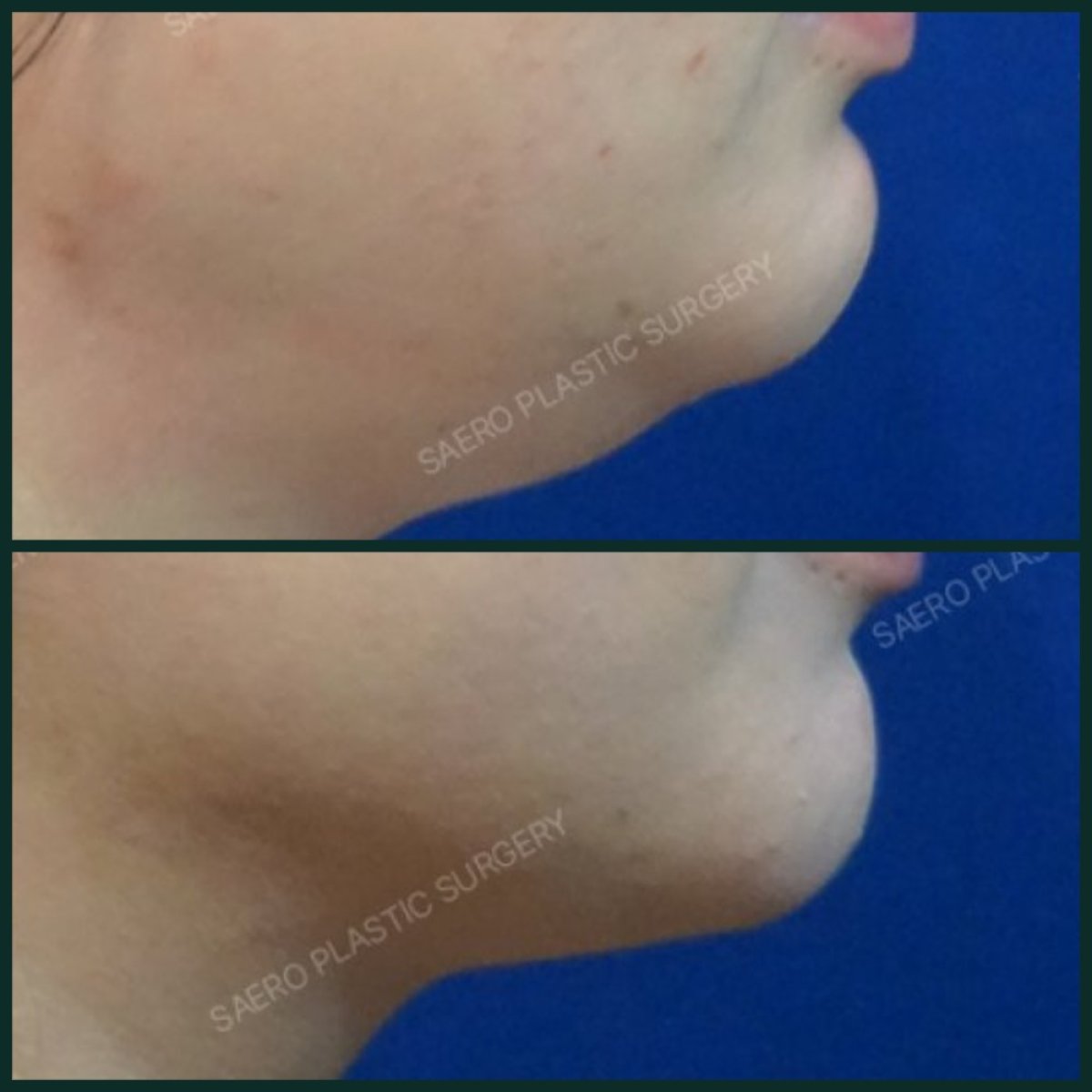 Resultados de liposucción de mentón y cuello antes y después en SAERO Plastic Surgery