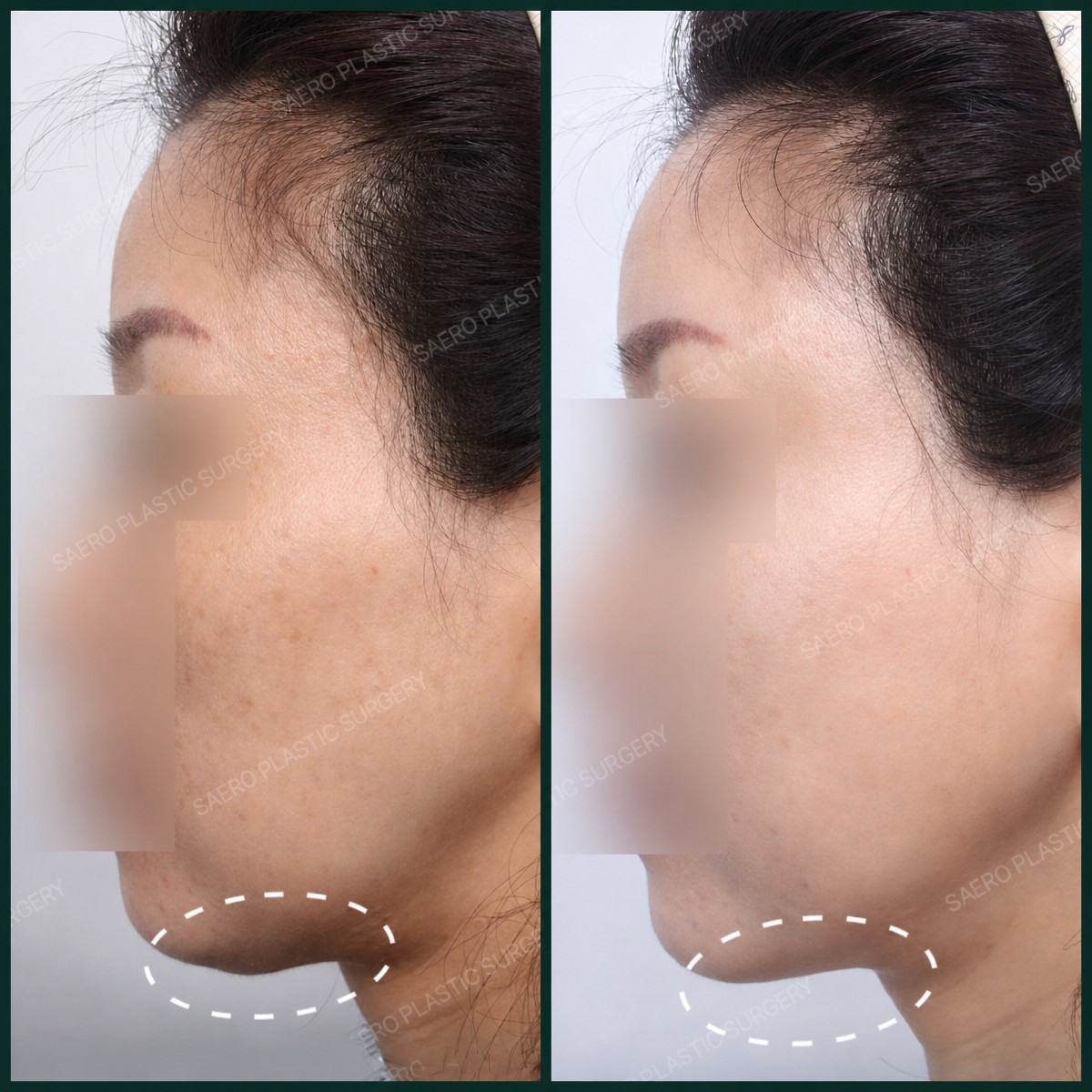 Before and after liposuction results at SAERO Plastic Surgery, improved jawline contour
