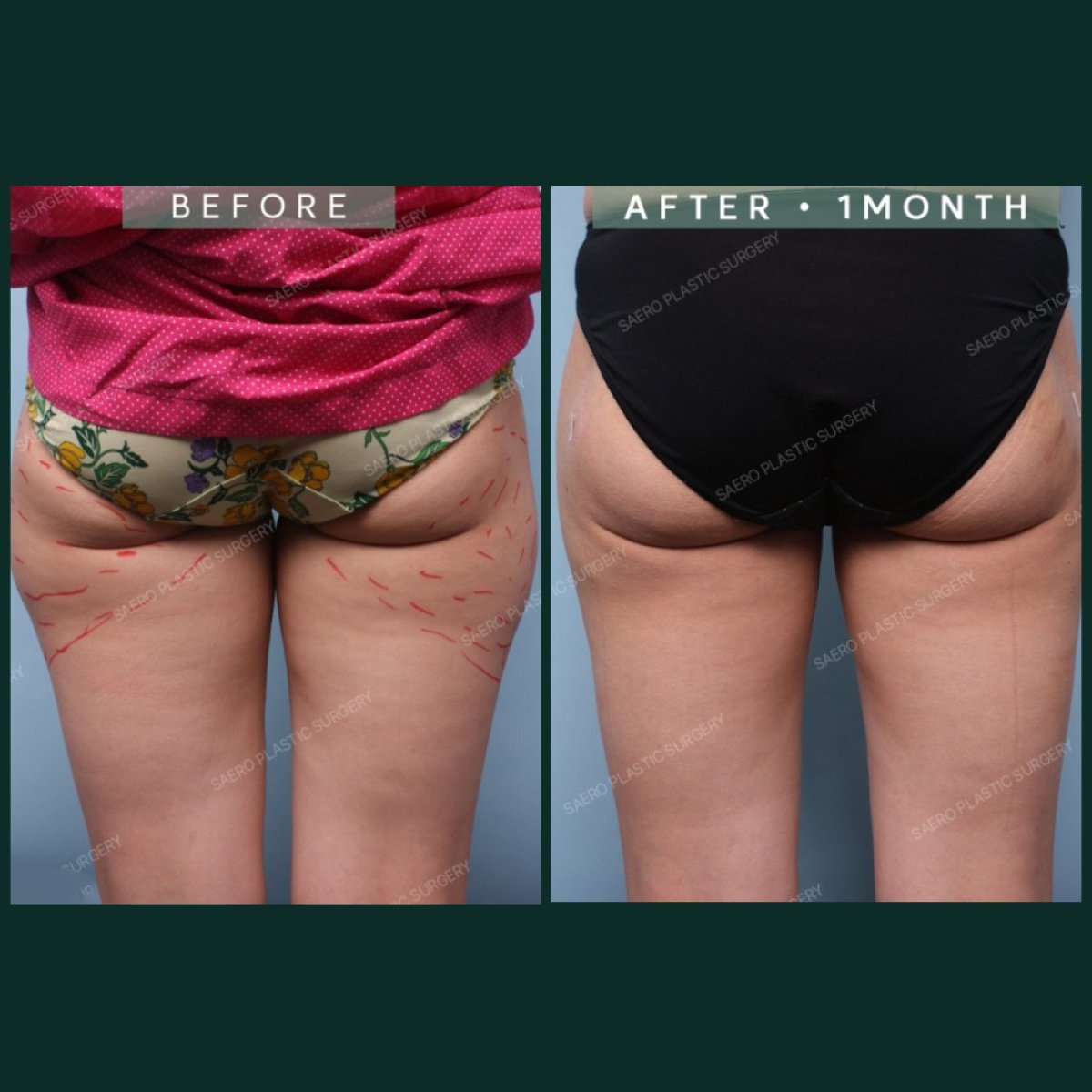 Before and after liposuction results at SAERO Plastic Surgery – slimmer thighs and hips