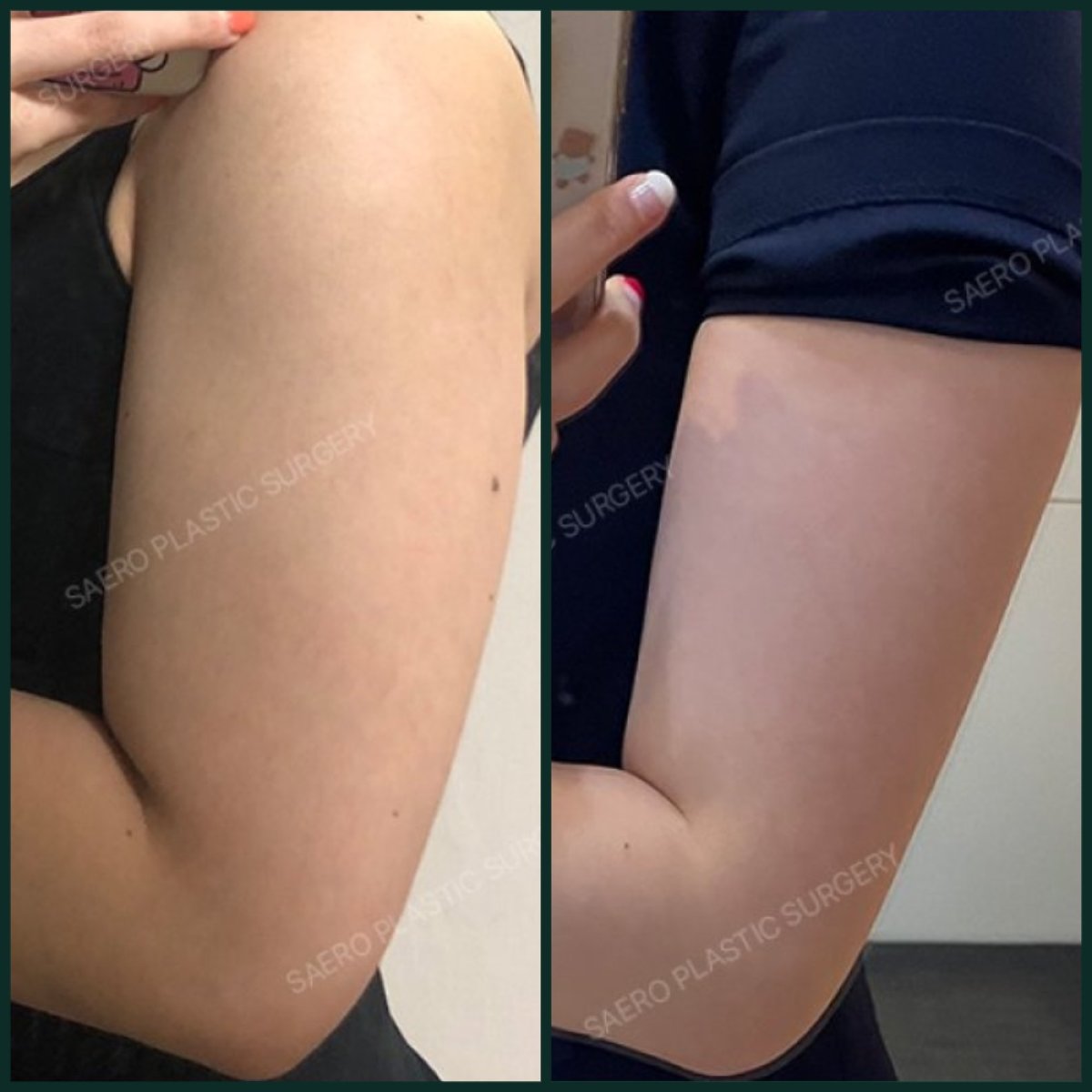 Resultados de liposucción de brazos antes y después en SAERO Plastic Surgery, mejora visible