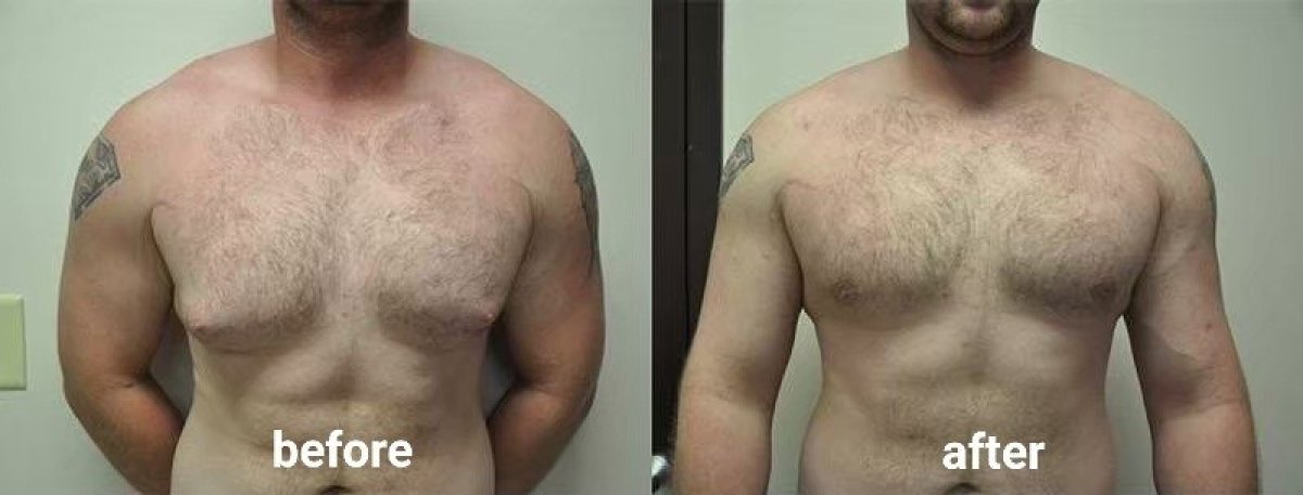 Before and after male chest liposuction results at ID Clinic Bangkok, improved contour visible