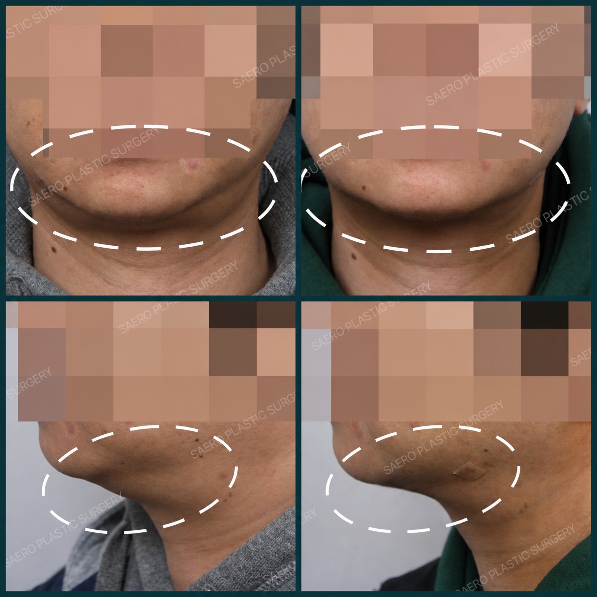 Résultats avant/après liposuccion chez SAERO Plastic Surgery, contour de mâchoire amélioré