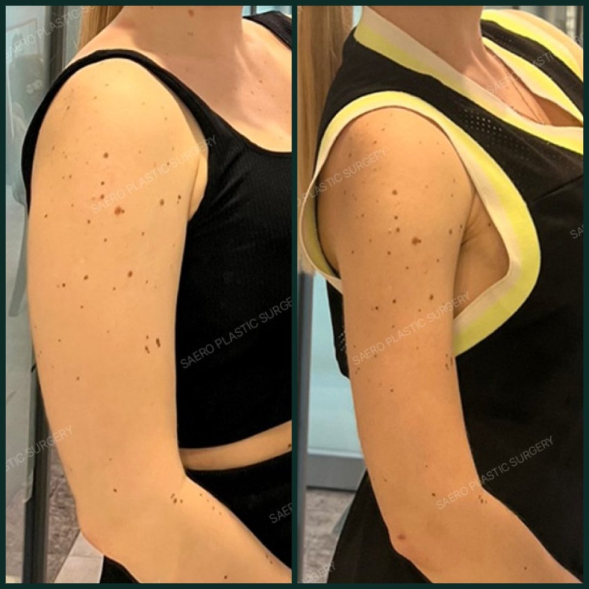 Resultados de liposucción de brazos antes y después en SAERO Plastic Surgery, contorno mejorado